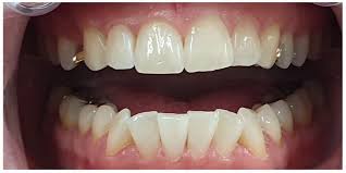 It often refers, specifically, to a dilute solution of sodium hypochlorite, also called liquid bleach. Bleaching Zahnaufhellung Weisse Zahne Fur Nurnberg