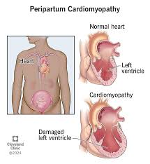 Image result for Cardiomyopathy