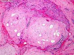 Multiple hamartomas throughout the body occur in cowden's disease. Webpathology Com A Collection Of Surgical Pathology Images