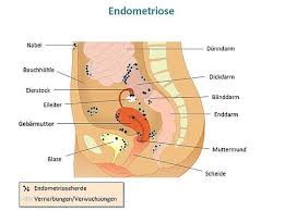 Endometriosis happens when the endometrium, tissue that usually lines the inside of your uterus, grows outside it. Was Ist Endometriose