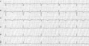 Long Qt Syndrom Fokus Ekg