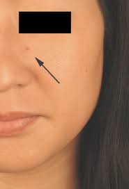 They can occur anywhere on your body, but they're mostly found on your torso, arms, legs, and even your face. Why Am I Getting Cherry Hemangiomas