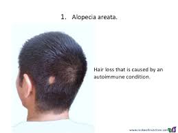 Are you facing excessive hair loss? Hair Loss Causes Treatment And Prevention