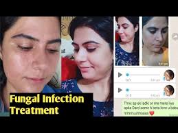 Fungal Infection Treatment || By natural beauty hair treatment ❤️❤️ Komal  Arora
