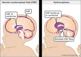 Image result for Hydrocephalus