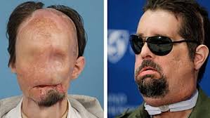 Face transplant deemed 'handsome' by daughter