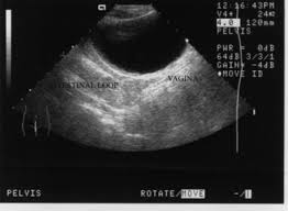 Other abnormalities include unilateral renal agenesis, skeletal abnormalities, hearing loss, and heart defects. Https Ispub Com Ijgo 5 1 13642
