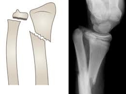 Image result for Galeazzi Sign