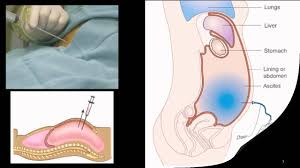 Ascites is when over 25 milliliters of fluid fills the space between the abdominal lining and the organs. Ascites Youtube