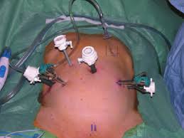 Needle entry was successful on the ﬁrst attempt in 97% of Port Placement For Robotic Radical Prostatectomy With A Three Arm Da Download Scientific Diagram