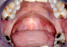 Image result for Erythroplakia roof of mouth