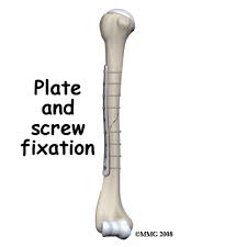 Image result for Humerus Growth Plates