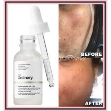 Alpha arbutin is extremely it is recommended to perform a patch test before incorporating any new product into your regimen. Vratovrzka Krehk Stlb Alpha Arbutin 2 Vegaweldingandfence Com