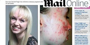 Miała straszne pryszcze, a teraz jest Miss!