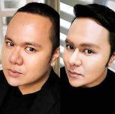 Get that V shape face by having your Buccal Fat removed. This is a surgical  procedure that extracts the buccal fat pad to reduce prominent cheeks and  achieve a slimmer and more