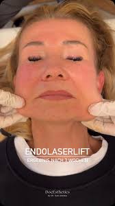 ⚠️TW Nadel zu sehen Vor ca 3 Monaten war ich bei @drtanjamitschele in  Ingolstadt und hab mir ein Endolift machen lassen ✨ Anzeige wegen Nennung  Ich muss echt sagen