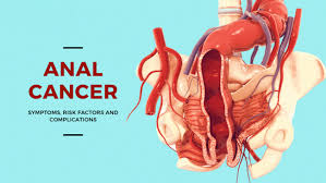 Anal Cancer- Cause, Symptom and Treatment- Southlake General Surgery