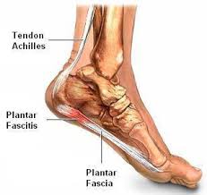 Antara keadaan yang paling biasa pada sakit tumit adalah keadaan yang dikenali sebagai plantar fascitis. Apakah Punca Tapak Kaki Sebelah Kanan Sakit Mrejoy