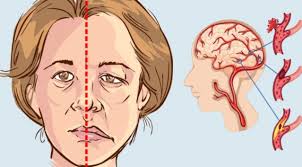 Emorragia cerebrale e ictus emorragico: Ischemia Cerebrale O Ictus Quali Sono I Sintomi Le Conseguenze E Le Cure