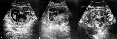 A set of nonuplets were born on 13 june 1971, in sydney, australia to geraldine brodrick and her husband leonard. Higher Order Multiple Gestations Glowm