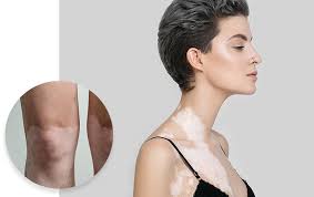If there are blood vessels under the skin, the patch may be slightly pink, rather than white. Vitiligo Treatment Queens Ny White Patches On Skin Treatment Bergen County Nj Long Island New York