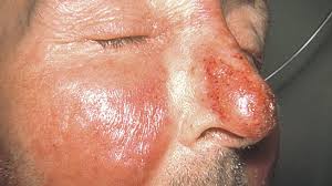 Image result for red rash face