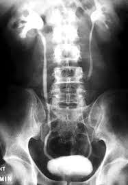 Image result for Nephrolithiasis Imaging