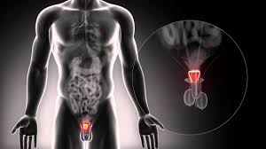 A cell's dna contains the instructions that tell a cell what to both prostate cancer and its treatment can cause urinary incontinence. Prostate Cancer Symptoms Diagnosis Treatment Urology Care Foundation