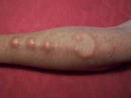 Body modification (or body alteration) is the deliberate altering of the human anatomy or human physical appearance. Implant Body Modification Wikipedia