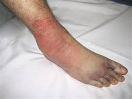 Image result for Compartment Syndrome