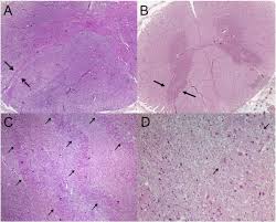 Anterior Horn Degeneration In Machado Joseph Disease Journal Of The Neurological Sciences