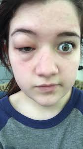 31 Allergic Reactions That Actually Hurt To Look At