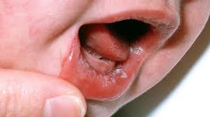 Image result for Oral thrush roof of mouth