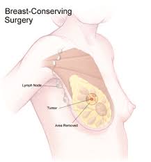Cancer can appear in the lymph nodes in two ways: Breast Conserving Surgery Lumpectomy Johns Hopkins Medicine