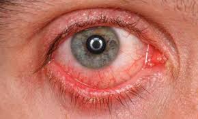Mata yang kedutan menjadi tanda adanya gangguan kesehatan pada tubuh. Sakit Mata Merah Bengkak Pedih Adakah Mudah Berjangkit Doctoroncall