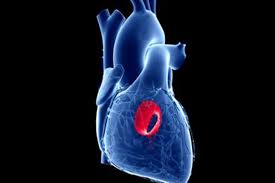 افتادگی دریچه میترال و مرگ ناگهانی - کلینیک قلب سلامت