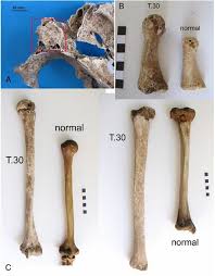 We'll explain the causes of gigantism, how to recognize the signs and symptoms of this condition, and treatment options — from. Paleopathologist Finds Gigantism In Third Century Roman Skeleton