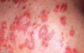 مرض الذئبة الحمراء لا يعرف له سبب محدد لكن ينتج عن تفاعل العوامل الوراثية مع العوامل البيئية ويصيب النساء الحوامل وقد ينشط بعد الحمل والولاده. Ø§ÙØ°Ø¦Ø¨Ø© Ø§ÙØ­ÙØ±Ø§Ø¡ ÙØ±Ø¶ Ø®Ø·ÙØ± ÙØµÙØ¨ Ø§ÙÙØ³Ø§Ø¡ Ø£ÙØ«Ø± ÙÙ Ø§ÙØ±Ø¬Ø§Ù ÙÙØ­ØªØ§Ø¬ Ø¥ÙÙ ÙØªØ§Ø¨Ø¹Ø© ÙØ³ØªÙØ±Ø© ØµØ­ÙÙØ© Ø§ÙØ§ÙØªØµØ§Ø¯ÙØ©