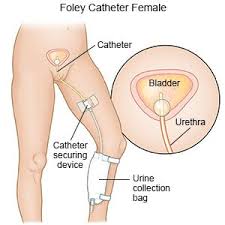 Foley Catheter Placement And Care What You Need To Know