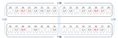 幼若永久歯のう蝕 | ファーストナビ歯科衛生士