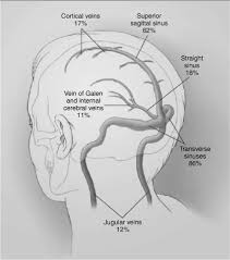 Risk factors for cvst included congenial coagulopathies, pregnancy and oral contraceptives. Management Of Sagittal Sinus Thrombosis In A Child Chapter 27 Case Studies In Pediatric Critical Care