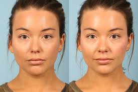 We treat all of our clients like they are part of our family, with a personal tear trough fillers: Contouring With Makeup Or With Fillers Kavali Plastic Surgery And Skin Renewal Center