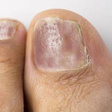 Image result for Pitting nails feet