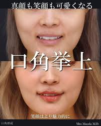 笑顔を創る口角を創る【口角挙上】術後１ヵ月 | MAe Clinic【マエクリ】