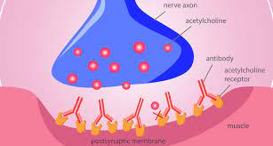 The microbiological study showed bacteria sensitive to the cefoperazone/sulbactam. Immunsuppressive Therapie Gegen Myasthenia Gravis Auch Bei