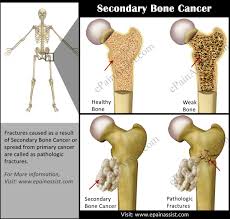 That's why it's crucial to understand the early signs of bone cancer, and whether you have developed bone metastases or primary. Secondary Bone Cancer A Cause For Pathologic Fracture