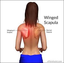 Here Is A Complete List Of Effective Exercises To Fix Your Winged Scapula Use The Exact Same Strategies That Has Work Scapula Winged Scapula Scapula Exercises