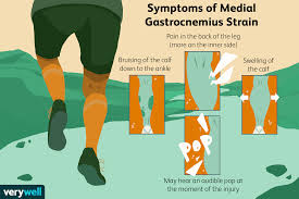 The term calf in calf muscle was derived from the old norse word, kaifi. Medial Gastrocnemius Strain Overview And Treatment