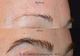 Whichever one, the procedure is done under local anesthesia. Everything You Need To Know About Eyebrow Transplants Spa And Beauty Today