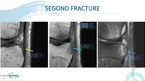 Image result for Segond Fracture